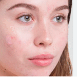 The 5 Best Acne Scars Treatment in Islamabad