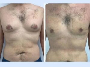 How to Overcome Surgery-Related Anxiety With Guidance From the Best Gynecomastia Surgeon in Dubai