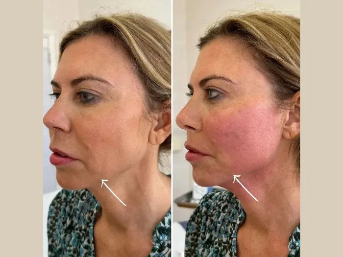 Prepping for Endolift Treatment in Dubai: What You Need to Know