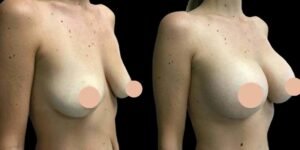 Top Reasons to Choose the Best Breast Augmentation Surgeon in Dubai for Your Transformation