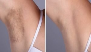 Best Aesthetic Clinics in Dubai for Flawless Laser Hair Removal Results