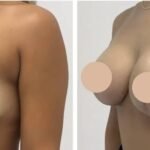 Recovery Tips from the Best Doctors in Dubai Breast Lift Surgery