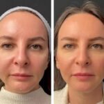 Mesotherapy Treatment in Dubai: Everything You Need to Know in 2025