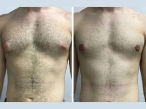 The Healing Timeline After Gynecomastia in Dubai