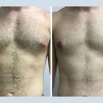 Best Doctors in Dubai for Male Breast Reduction with Guaranteed Results