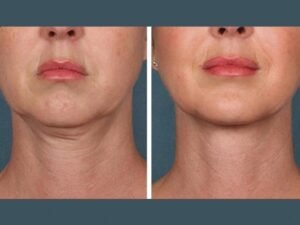 Best Aesthetic Clinics in dubai for PRP Injections for Fine Line Reduction