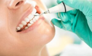 How Teeth Scaling in Islamabad Contributes to Dental Longevity