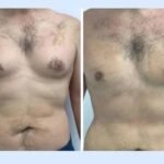 Best Doctors in Dubai for Gynecomastia: Qualifications to Look for in a Surgeon