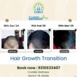 Restore Your Confidence with Advanced Hair Loss Treatment in Noida – Coddle Wellness