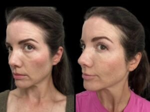 How the Best Doctors in Dubai Combine Technology and Art for Dark Circles Treatment