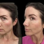 Dark Circles Under Eyes: Best Treatment Options from the Best Doctors in Dubai