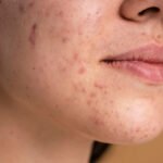 Transform Your Skin | Laser Acne Scar Removal Experts