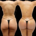 Should Know About Butt Fat Transfer Surgery in Dubai
