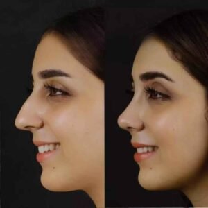 Best Septoplasty Surgeons in Dubai: Redefining Nasal Correction Excellence