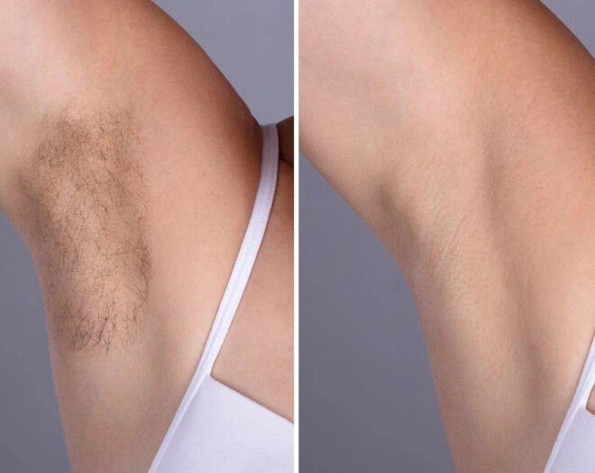 Best Doctors in dubai Using FDA-Approved Laser Hair Removal Machines