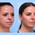 Discover Youthful Facial Lifting Benefits Through Advanced Thread Lift Treatments in Dubai Today