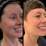 Elevate Your Skin Look using Profhilo and Best Doctors in dubai