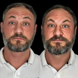 Refines Your Look with using Profhilo and Best Doctors in dubai