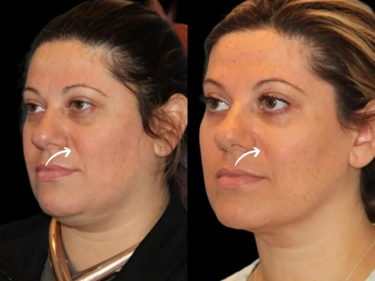 Best Aesthetic Clinic in Dubai: Sculptra Lift Plan