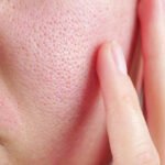 Affordable and Safe Large Pores Treatment in Islamabad
