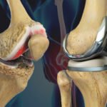 Best Orthopedic Surgeon in Vaishali Nagar Jaipur – Dr. Arvind Asopa