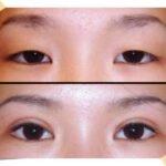 Cosmetic Eyelid Surgery Islamabad – Younger, Brighter Eyes