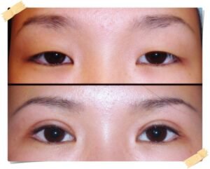 Cosmetic Eyelid Surgery Islamabad – Younger, Brighter Eyes