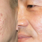 Acne Scar Improvement Treatments in Dubai & Sharjah | Glamorous Clinic Dubai