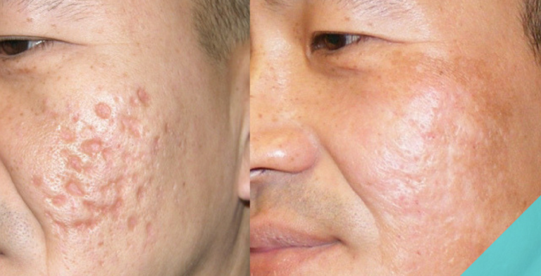 Acne Scar Improvement Treatments in Dubai & Sharjah | Glamorous Clinic Dubai