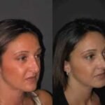 كيف تختار الجراح المناسب لعملية تجميل الأنف في الرياض؟