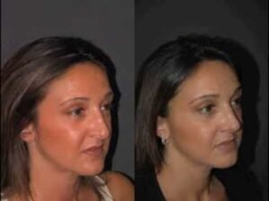 كيف تختار الجراح المناسب لعملية تجميل الأنف في الرياض؟