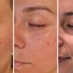 Trusted Cosmelan Peel Specialists in Dubai | Glamorous Clinic