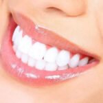 Laser Teeth Whitening in Islamabad: Frequently Asked Questions