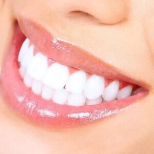 Laser Teeth Whitening in Islamabad: Frequently Asked Questions