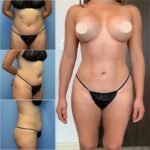 Body Contouring in Dubai: Sculpt Your Ideal Silhouette