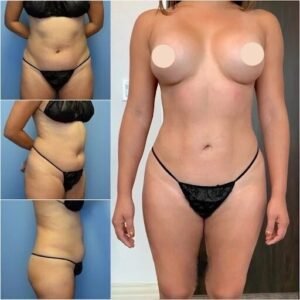 Body Contouring in Dubai: Sculpt Your Ideal Silhouette
