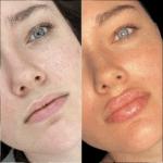Fillers Treatment in Dubai for Customized Beauty Goals