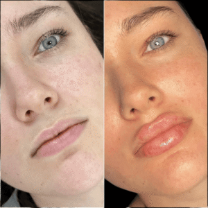 Fillers Treatment in Dubai for Customized Beauty Goals