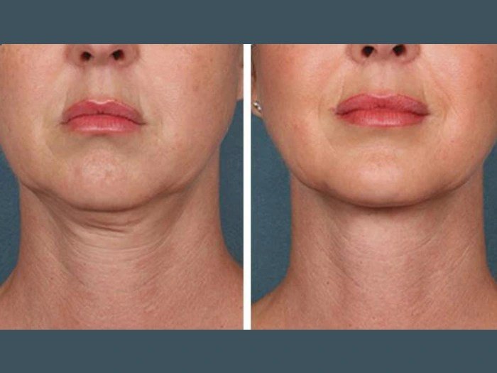 Best Doctors in Dubai Providing PRP Treatment for Skin Rejuvenation