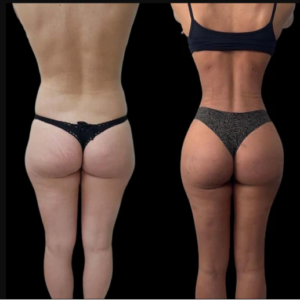 Why Patients Trust the Best Doctors in Dubai for Their J-Plasma Procedures