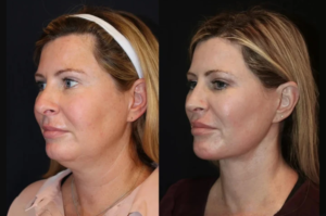 Skin Tightening Success Stories with the Best Doctors in Dubai