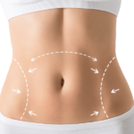 Perfect Abdomen Shape | Modern Cosmetic Solutions Islamabad