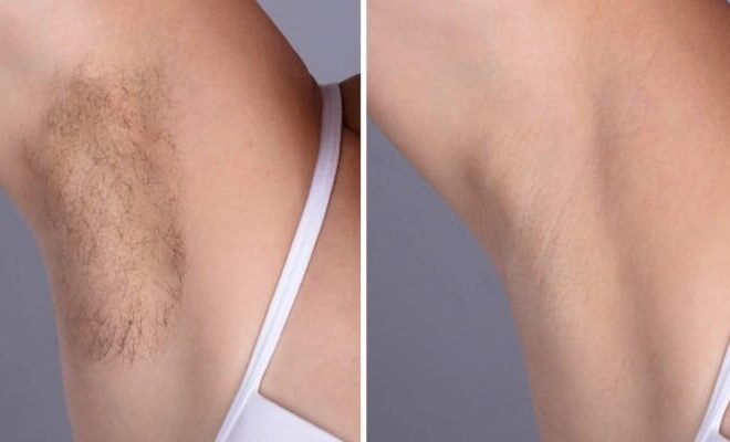 Laser hair removal in Dubai: A Modern Beauty Essential