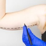 The “Shrink-Wrap” Effect: Firming Up with Arm Lift Surgery in Riyadh
