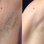 Best Aesthetic Clinics in Dubai Ensuring Safe Electrolysis Laser Hair Removal in Dubai