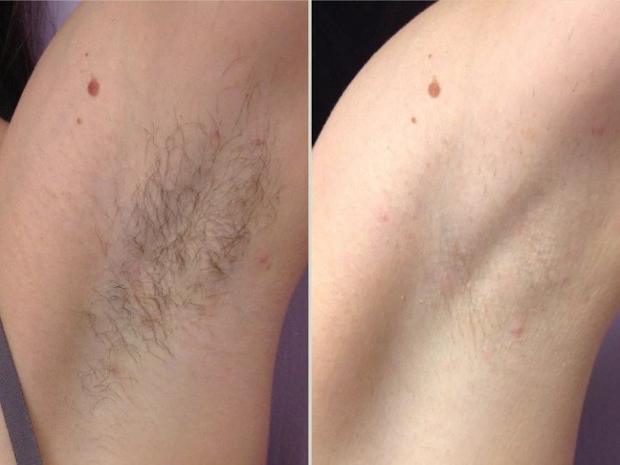 Best Aesthetic Clinics in Dubai Ensuring Safe Electrolysis Laser Hair Removal in Dubai