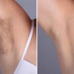 Laser Hair Removal Treatment in Dubai: Benefits for Women and Men