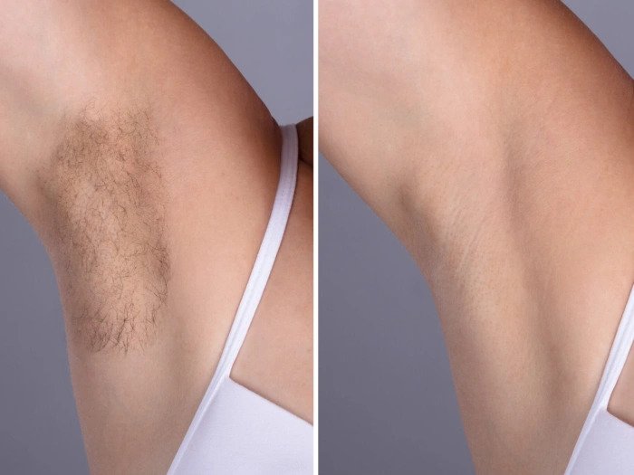 Laser Hair Removal Treatment in Dubai: Benefits for Women and Men