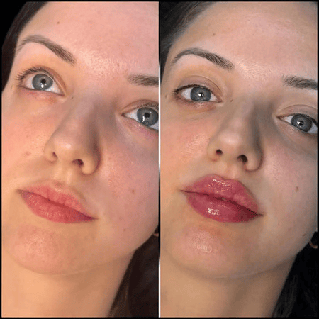Best Aesthetic Clinics in dubai for Custom Fillers Mapping