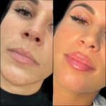 Confidence Restored with Expert Fillers in Dubai